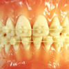 歯の表側からの矯正