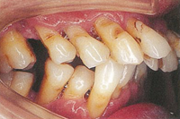 病的歯牙移動（後天的な出っ歯など）